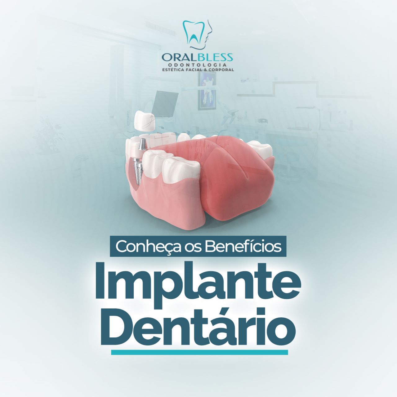 Implantes Dentários